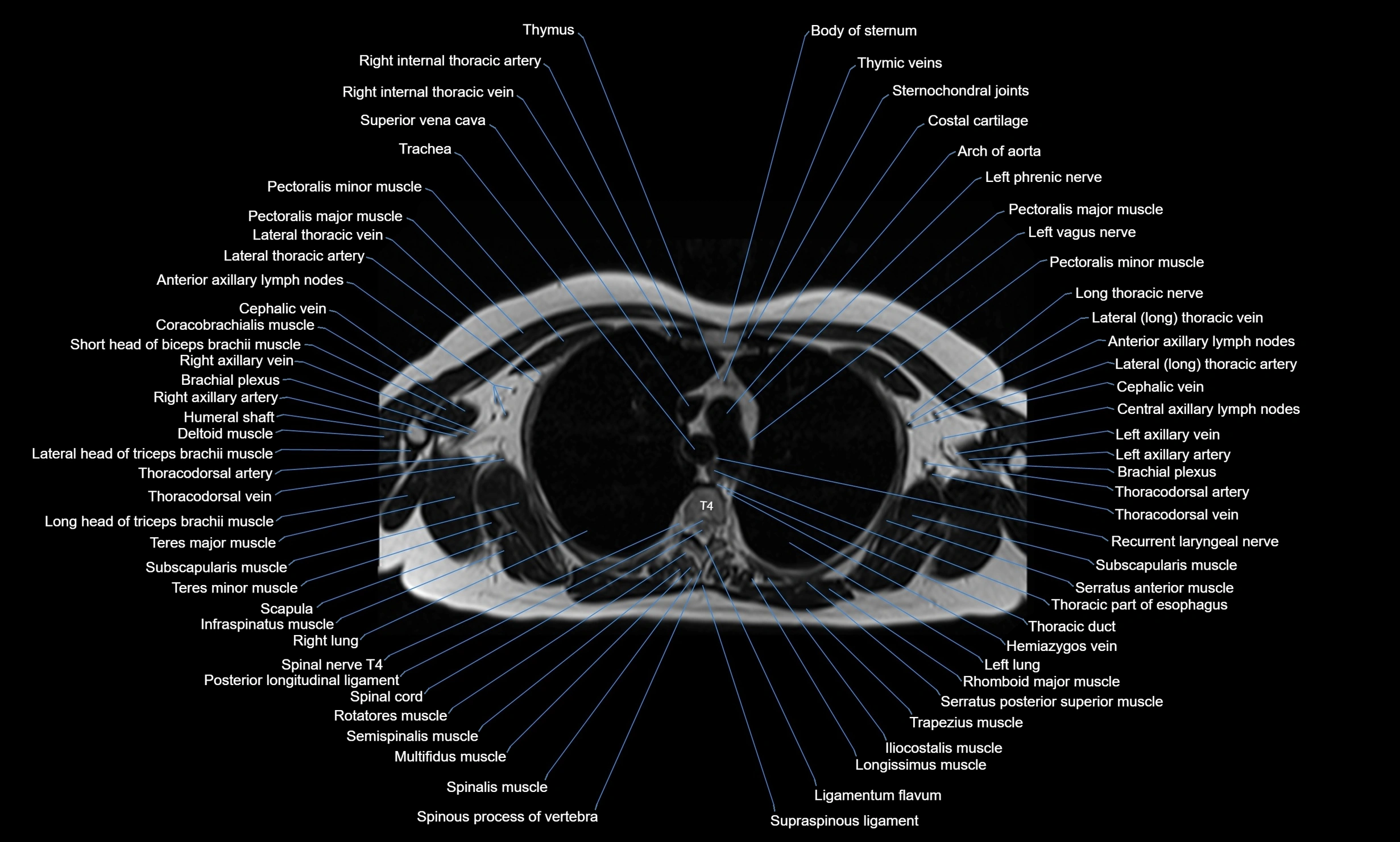 MRI chest axial  cross sectional anatomy 3T radiology  image-img-00001-00015.webp